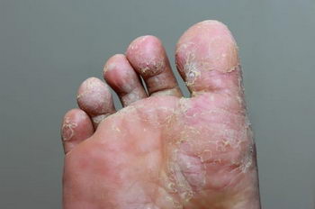 Athletes foot treatment