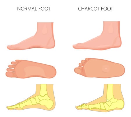 Charcot Foot Deformity